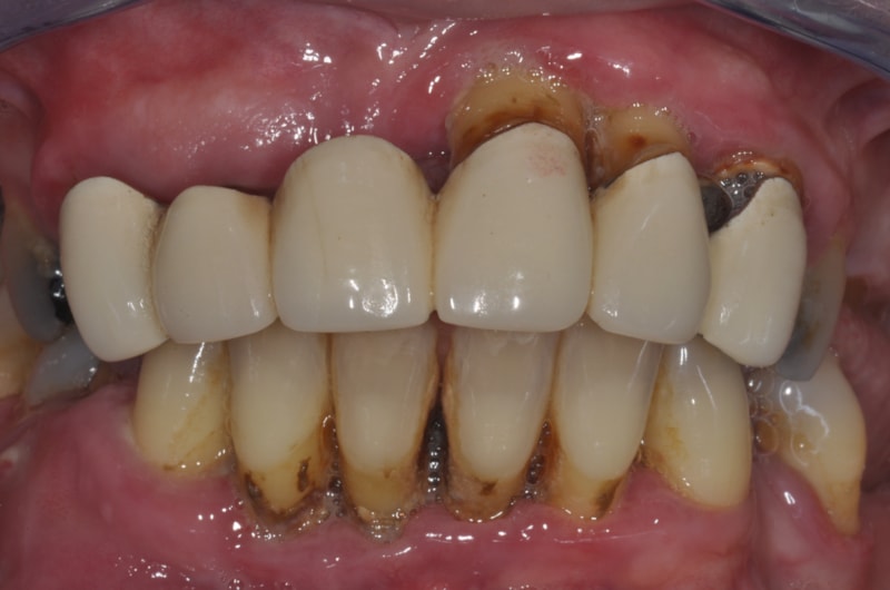 Parodontitis, unschöne Kronen, drohender Zahnverlust